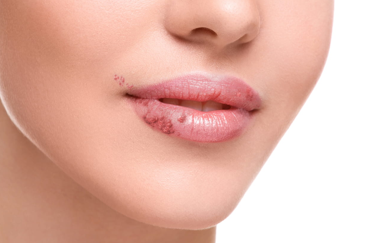 Ärgerlich an der Lippe: Herpes – und was Sie darüber wissen sollten